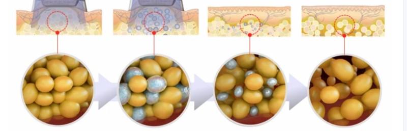 Cryolipolysis Fat Freezing Machine Combine CRYO And Shock Wave Therapy