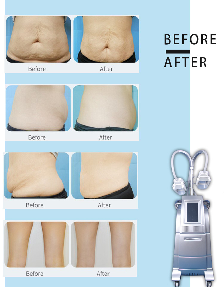 Professional cryo fat beauty machine fatest slimming weight loss cryo equipment LF-207B