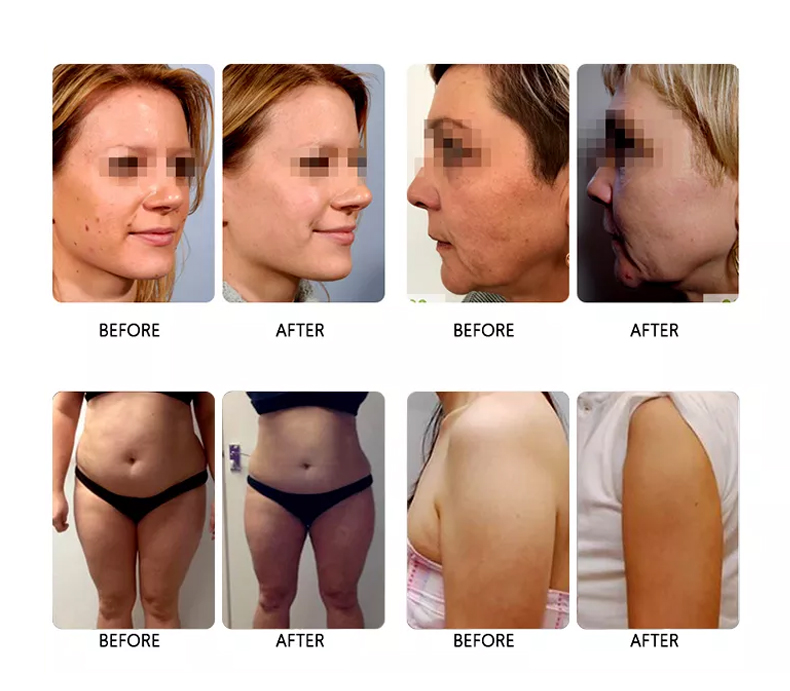 Anti Aging HIFU Slimming Machine Skin Care 7D Non Surgical Liposuction