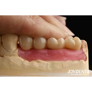 Ultra-precision processing Zirconia Implants All-Zirconium Integrated Crown