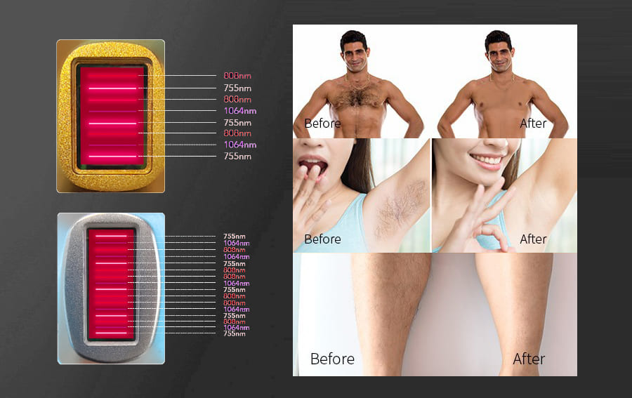 Medical Laser Hair Removal Equipment 755 808 940 1064nm Laser Hair Removal Machine Salon