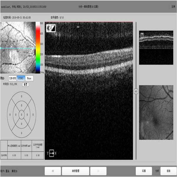 Noninvasive Ophthalmology Oct Machine 2.5mm High Definition Image PC Inside
