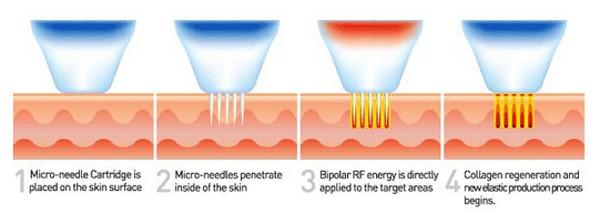 Best Fractional RF microneedle for skin rejuvenation acne removal collagen