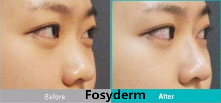 Skin Care HA Cross Linked Dermal Filler For Face Injectable Long Lasting