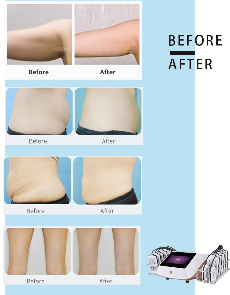Best Sale Lipo Laser 14 Pads LED lipolaser slimming beauty machine / fat burning laser LF-129c