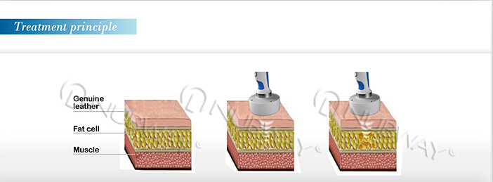 HOT SELLING!!! portable HIFUSHAPE SIMMING MACHINE FOR WEIGHT LOSS