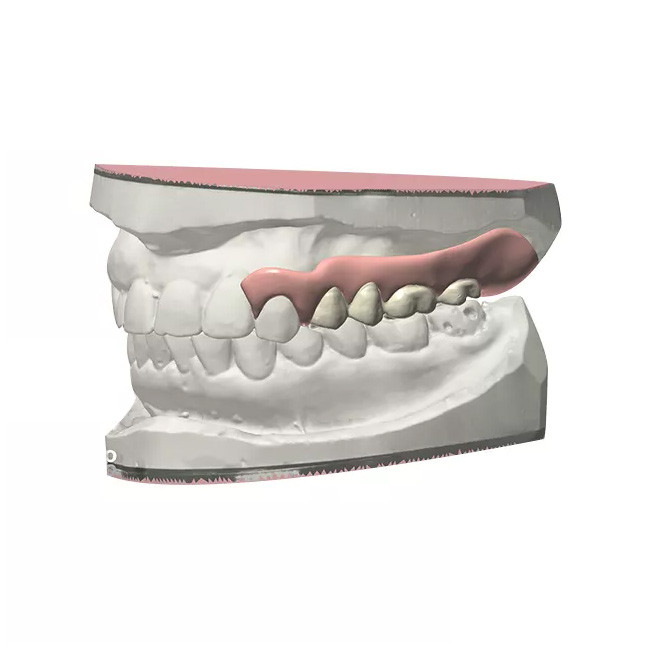 High Chewing Efficiency Denture Dental Lab CAD / CAM Fixed Partial Denture