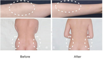 Hot selling!!! Laser Liposuction Beauty Equipment for Fat Reducing