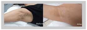 newest model amazing result ipl machine,ipl laser hair removal machine