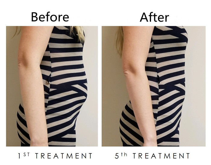 360 Degree Cryolipolysis Coolsculpting Machine Aesthetics Slimming