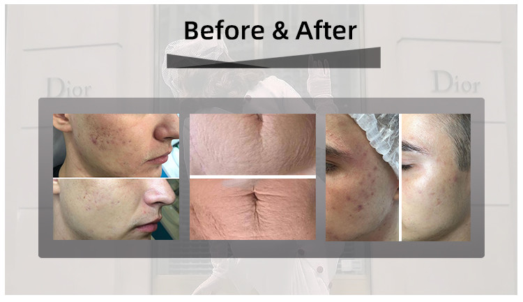 Professional 5000hz Co2 Fractional Laser Machine Ce