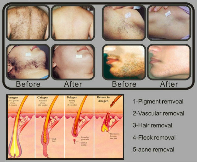 FDA technology most advanced painfree efficient ipl laser hair removal machine for sale