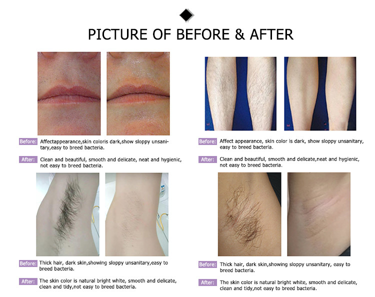 epilator new design powerful body hair removers equipment permanent portable machine diod diode hair removal laser 808