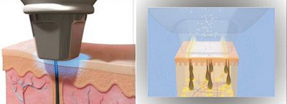 808nm Vertical Diode Laser Hair Removal High Energy Machine For Distribution