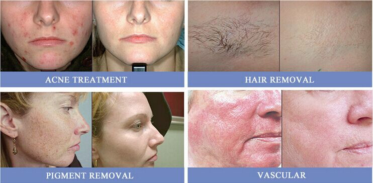 cavitation weight loss ipl hair removal ultrasonic cavitation slimming machine