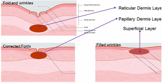 Remarkable treatment effect for Wrinkle Remover and skin rejuvenation professional rf co2 fractional laser beauty machine
