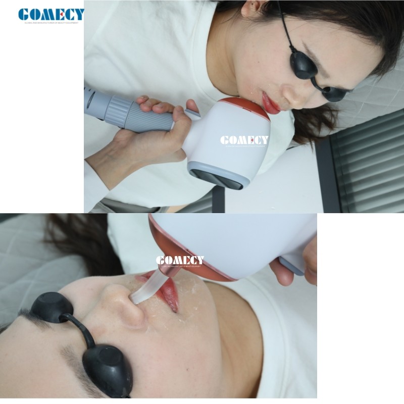 808 Diode Laser Hair Removal Machine Facial Skin Rejuvenation 808 755 1064Nm Laser Diode 808 Nm