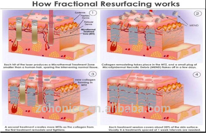 10600nm Metal Tube RF Fractional Laser Cutter Machine Skin Resurfacing