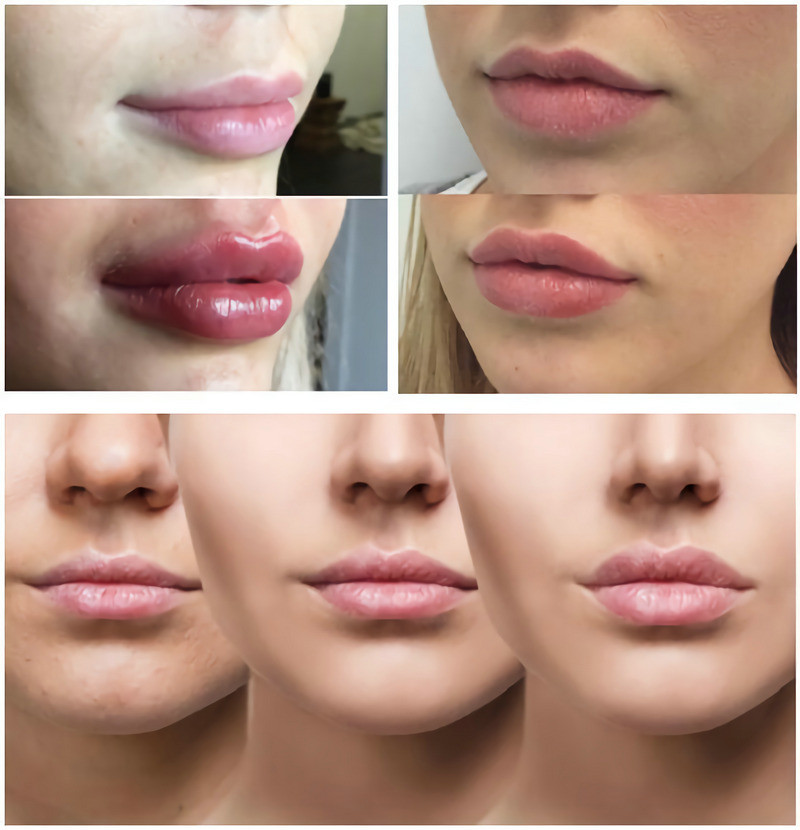 Hyaluronic Acid Lip Injections Natural Looking Lip Fillers Non Surgical Lip Enhancement