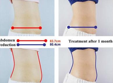 Fat Effective Cryolipolysis Machine,Cryolipolysis Slimming Machine,Cryolipolysis Equipment