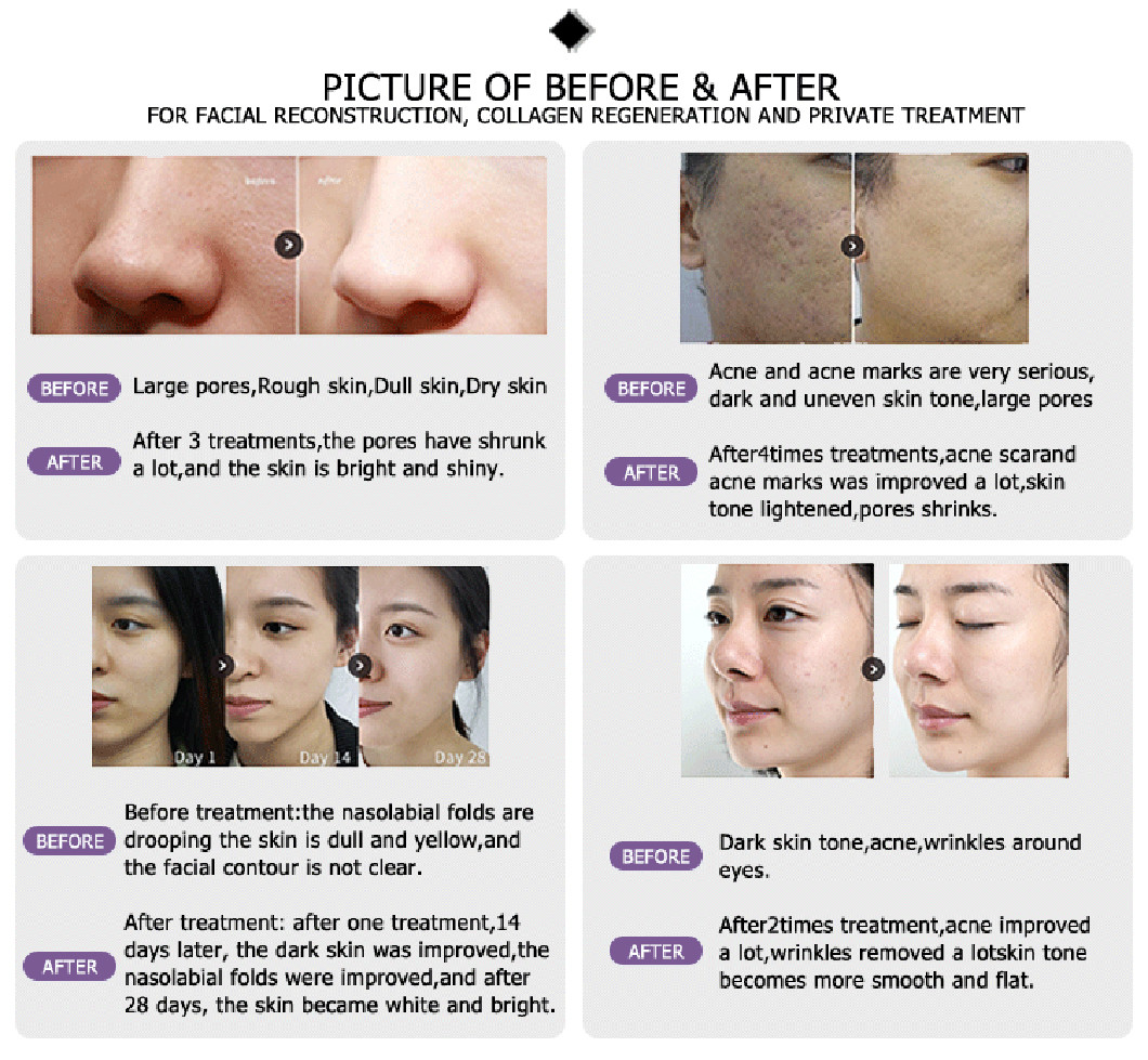2021 Newly launched OEM ODM approved facelift fractional laser skin treatment for skin tightening