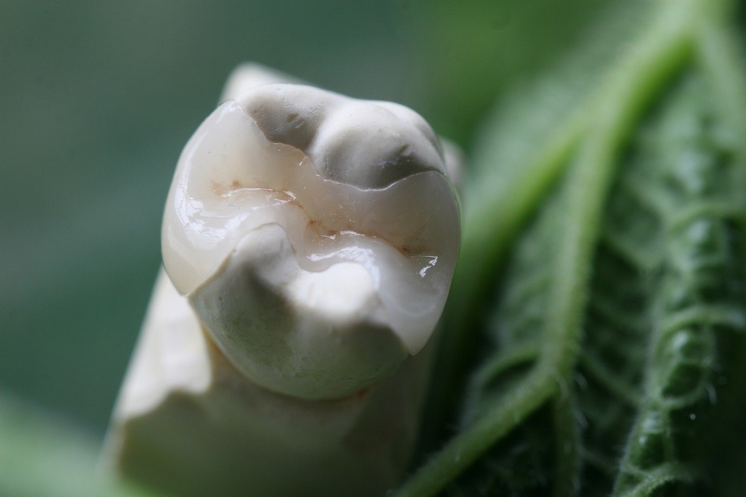 Onlay And Inlay Esthetic Artificial EMAX Dental Crown