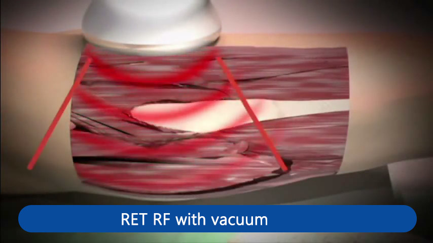 Pain Removal Tecar Therapy Machine Vacuum Ret Cet Physiotherapy Beauty High Frequency 448KHZ