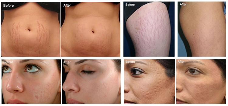 Scars Remodeling RF Microneedling Machine Skin Whitening 5MHz
