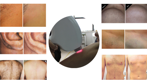 12*20 big spot 808nm portable diode laser hair removal/laser hair removal machine diode