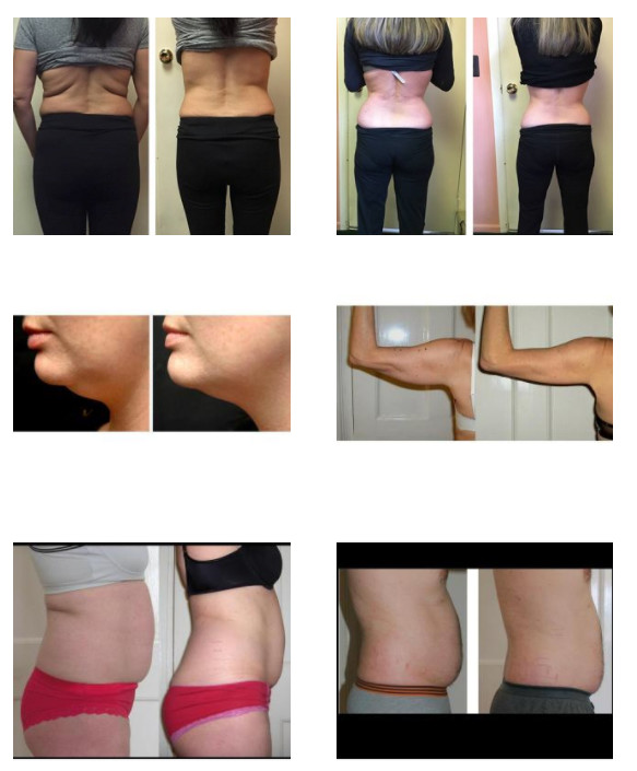 86 Kpa Ultrasonic Cryolipolysis Slimming Machine 360 Angle Surrounding