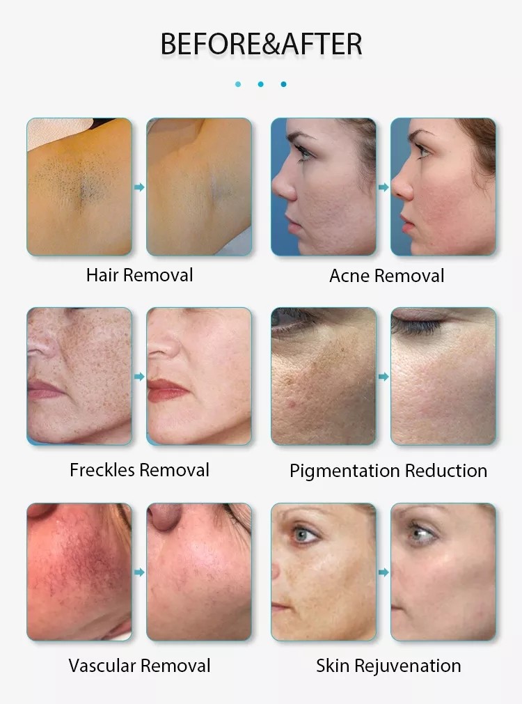 Elight Shr Rf Q Switch Portable Laser Hair Removal Device Multi Function Ipl Machine