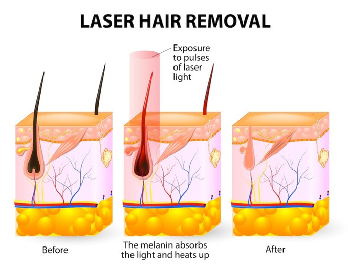 Permanent Hair Removal Nova Ice Diode Laser Machine 3 Wave 808nm
