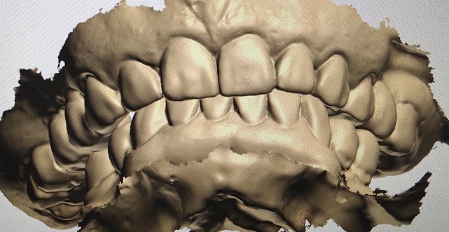 CAD CAM Design Digital Display Mockup Teeth Other Dental Products