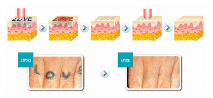 3 In 1 Nd Yag Laser IPL SHR Hair Removal Machine Vascular Treatment Body Slimming