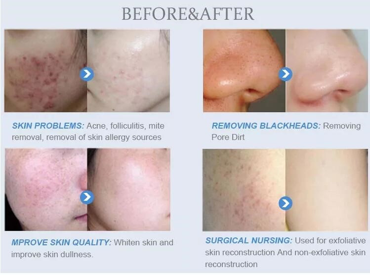 Salon H2O2 Hydra Facial Machine , 7 In 1 Hydra Dermabrasion Machine