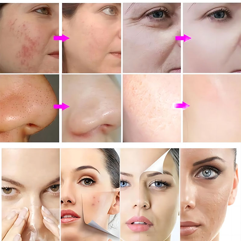 Customizable Hydra Beauty Machine 14+3 For Face Lifting Acne Treatment