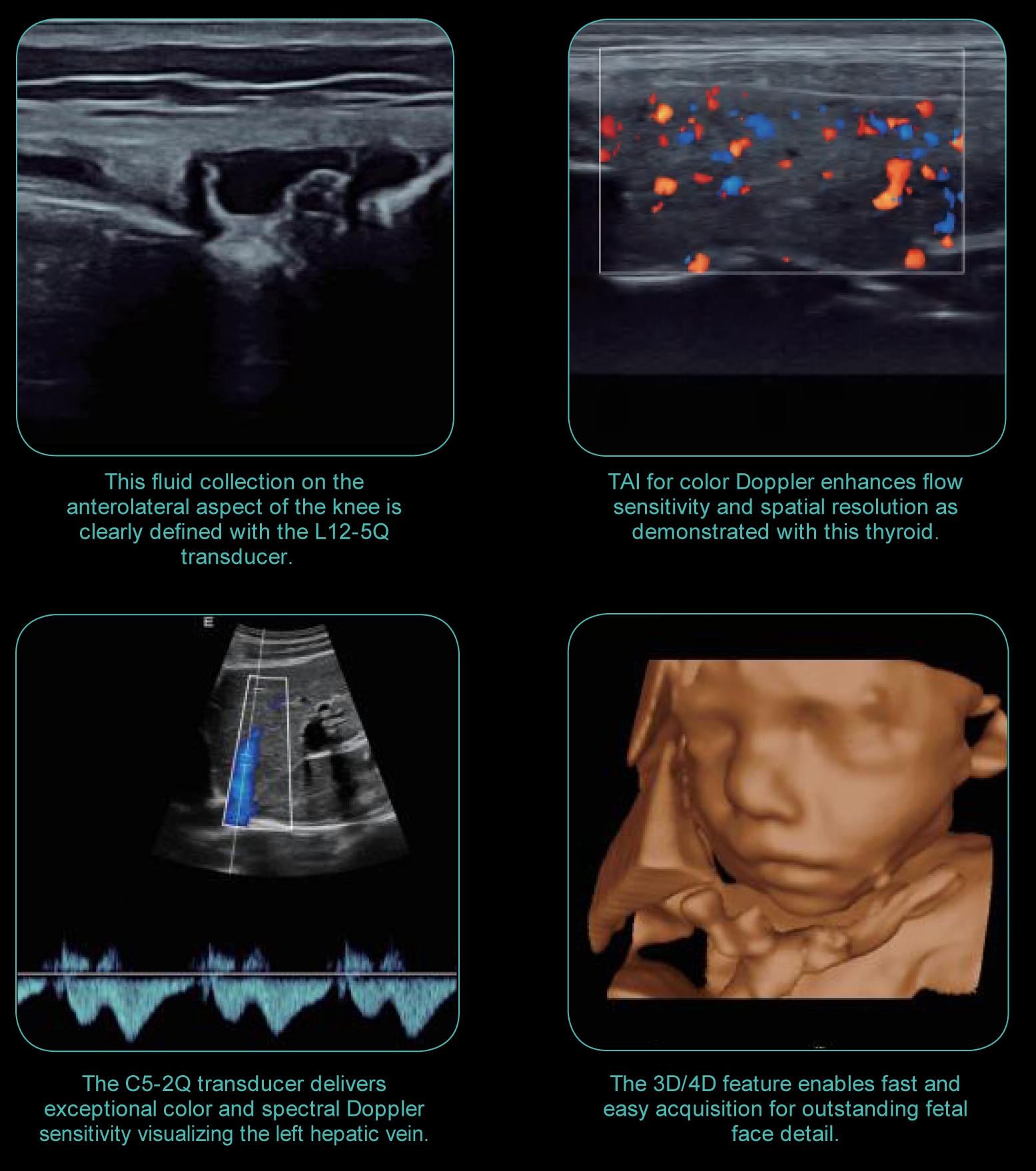 Edan AX4 Laptop 3D/4D Color Doppler Ultrasound scanner