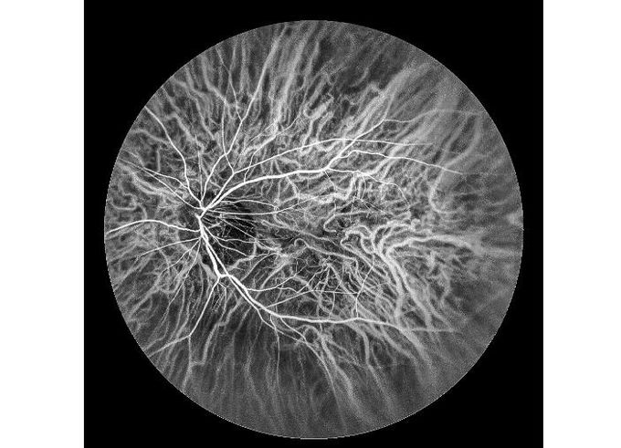 Ultra-wide Field Laser Scanning Retina Angiograph Digital Ophthalmic Equipment With Optical Zoom 100°/60°/30°