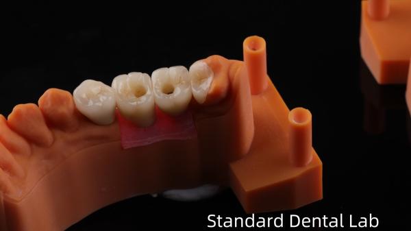 Screw Retained Dental Implant Crown with PFZ Porcelain Layered Zirconia 5-Year