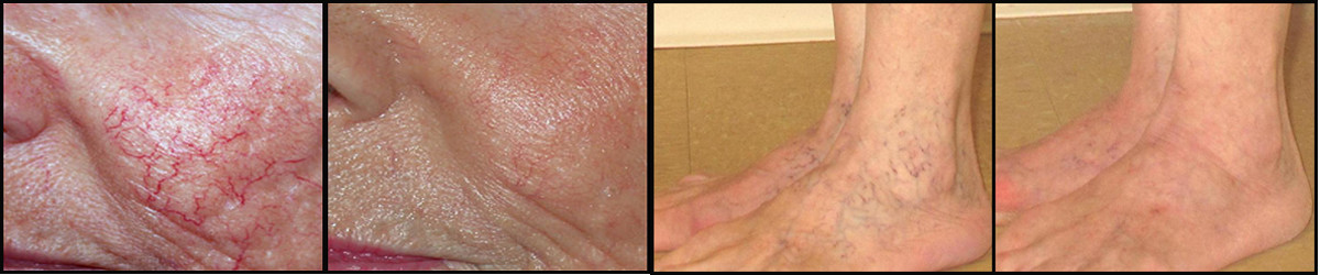 Laser treatment for spider veins on face vascular veins removal machine