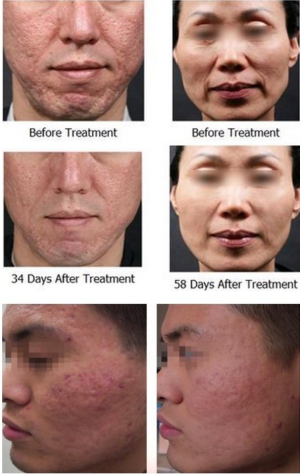 Fractional RF Microneedle For Wrinkle Removal / Skin Tightening