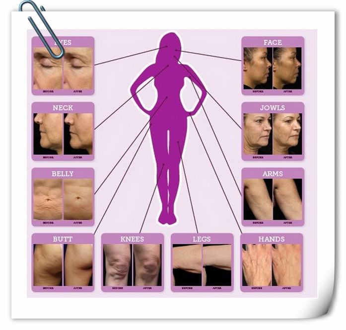 Micro needling for wrinkles stretch mark removal beauty RF skin machine for sale