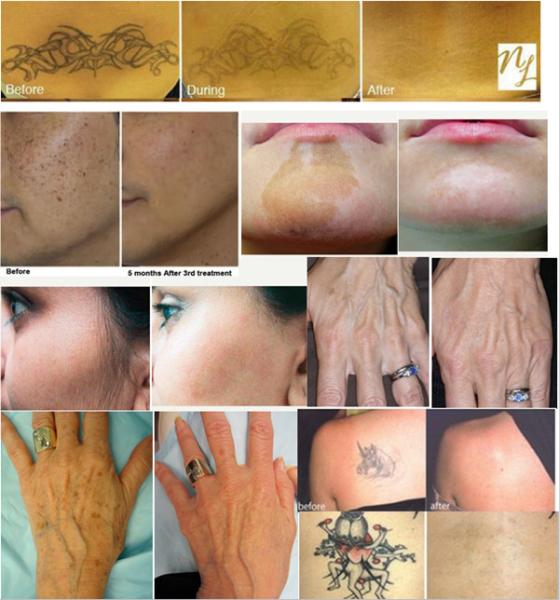 laser tattoo removal equipment / nevus of Ota removal machine