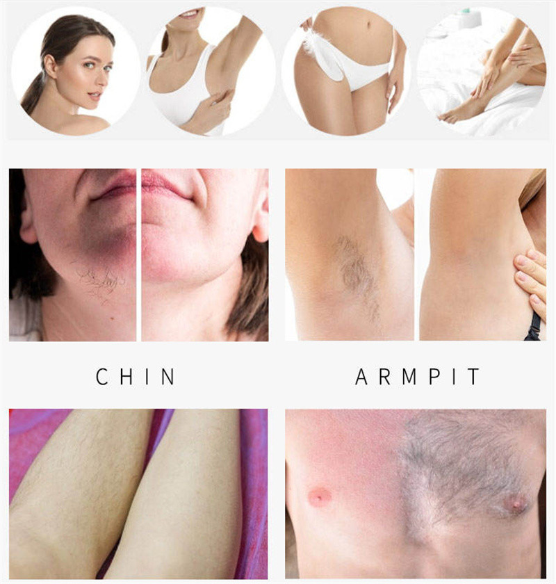 Professional 808nm Diode Laser Hair Removal Machine Oem Odm Permanent