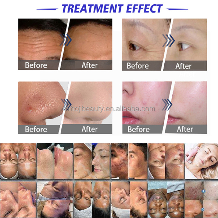 Customizable Hydra Beauty Machine 14+3 For Face Lifting Acne Treatment