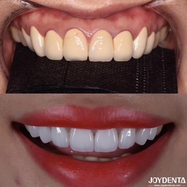 CAD/CAM Compatible Zirconia Dental Crowns Precision Manufacturing For Tailored