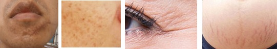 Mini RF beauty machine,Radio Frequency Face lifting RF Lifting machine, microneedle rf