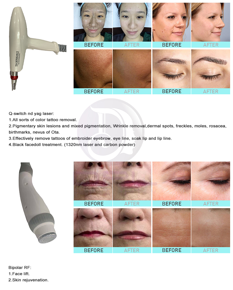 AS828 Multifunction Opt Ipl Machine , Rf 4 In 1 Ipl Nd Yag Hair Removal Machine