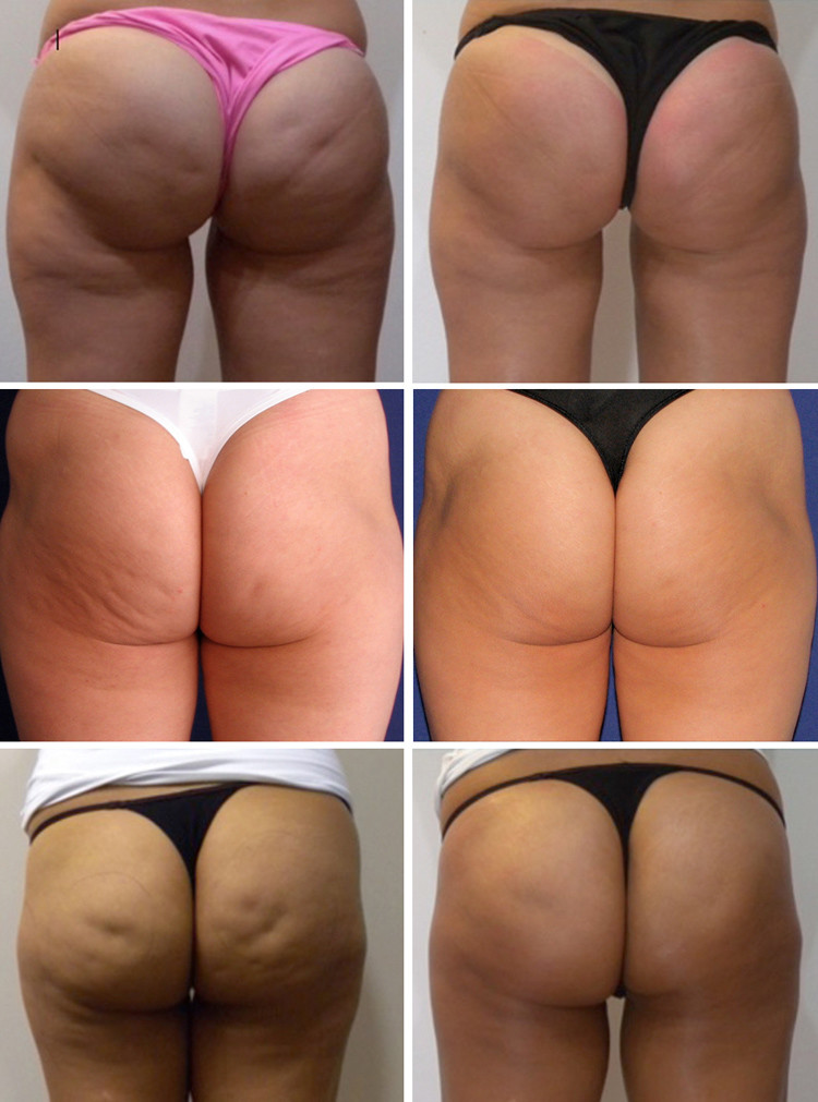 ESWT Shockwave Therapy for Penile Enhancement