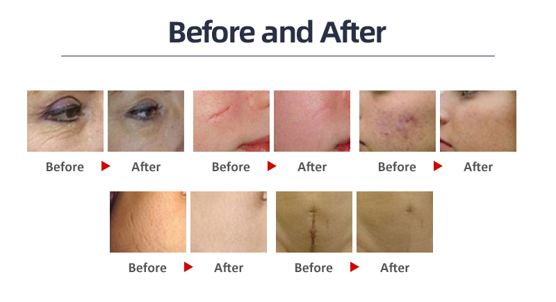 20mm Spot Fractional Co2 Laser Machine for Acne Removal and Skin Rejuvenation